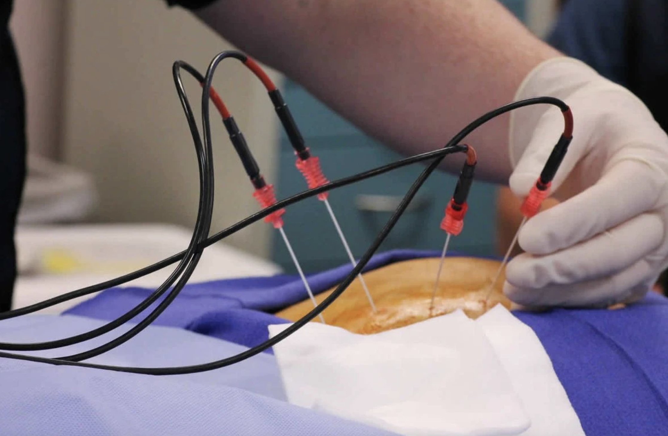 Radiofrequency Ablation Radiofrequency Ablation