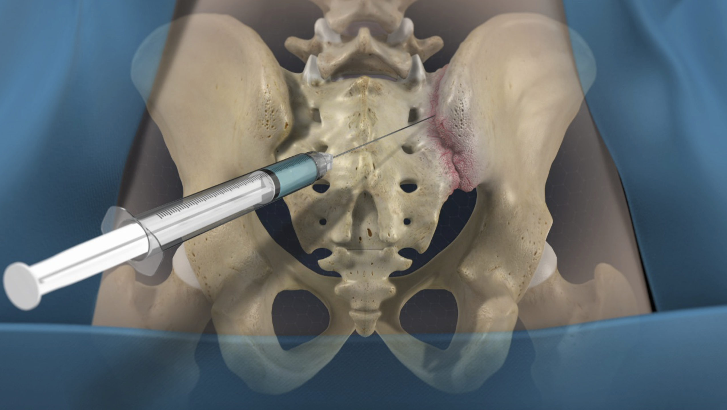 Sacroiliac Joint Injections Sacroiliac Joint Injections