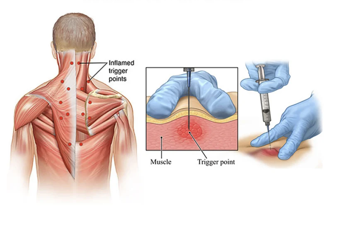 Trigger Point Injection Trigger-Point-Injection