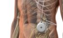 Intrathecal Drug Delivery Systems