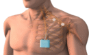 How Peripheral Nerve Stimulation (PNS) Works for Managing Neuropathic Pain