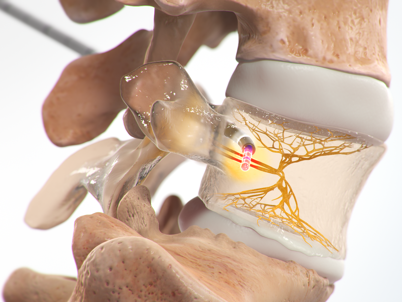 vertex-intracept-procedure-preview